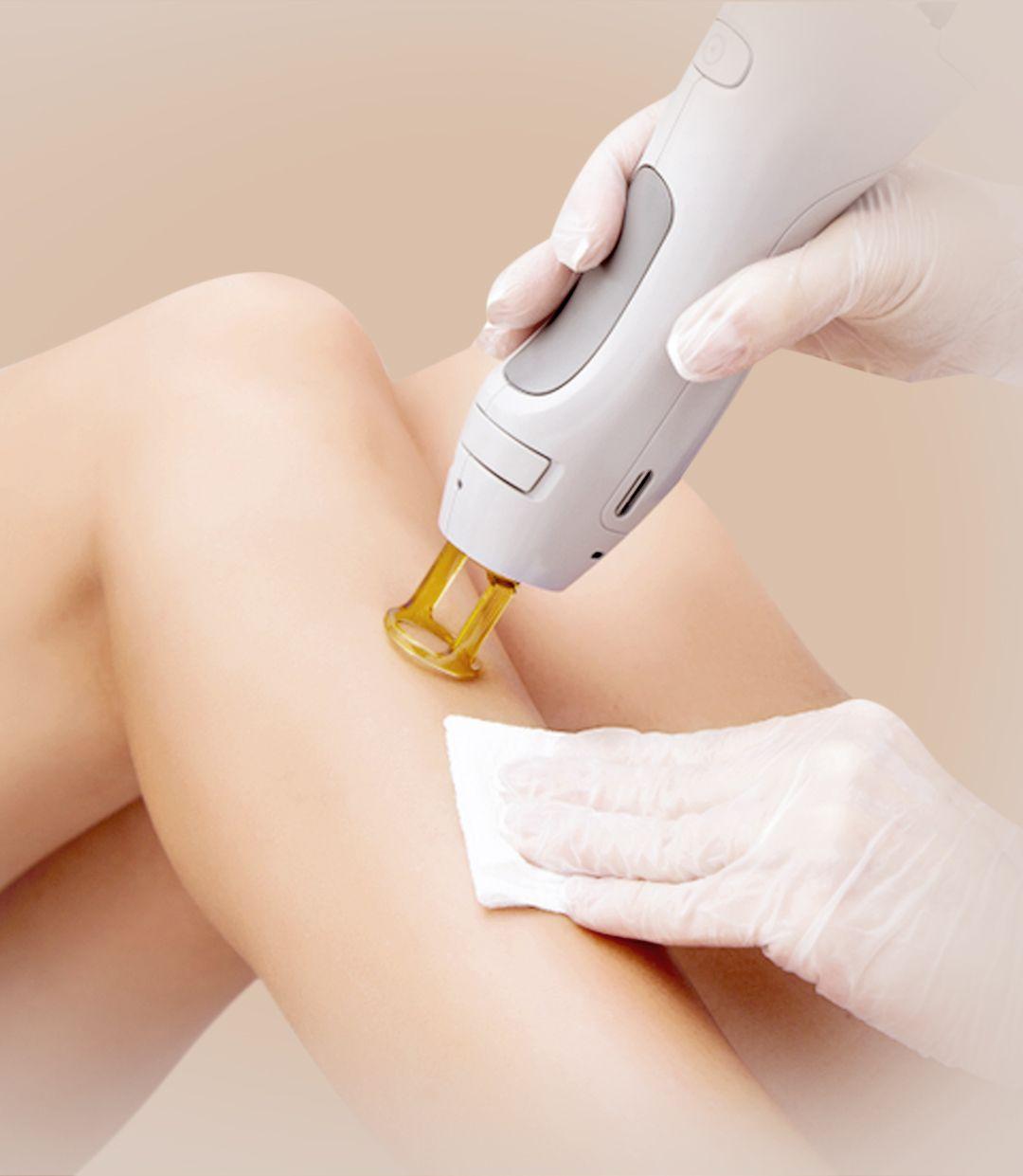 Laser Hair Removal