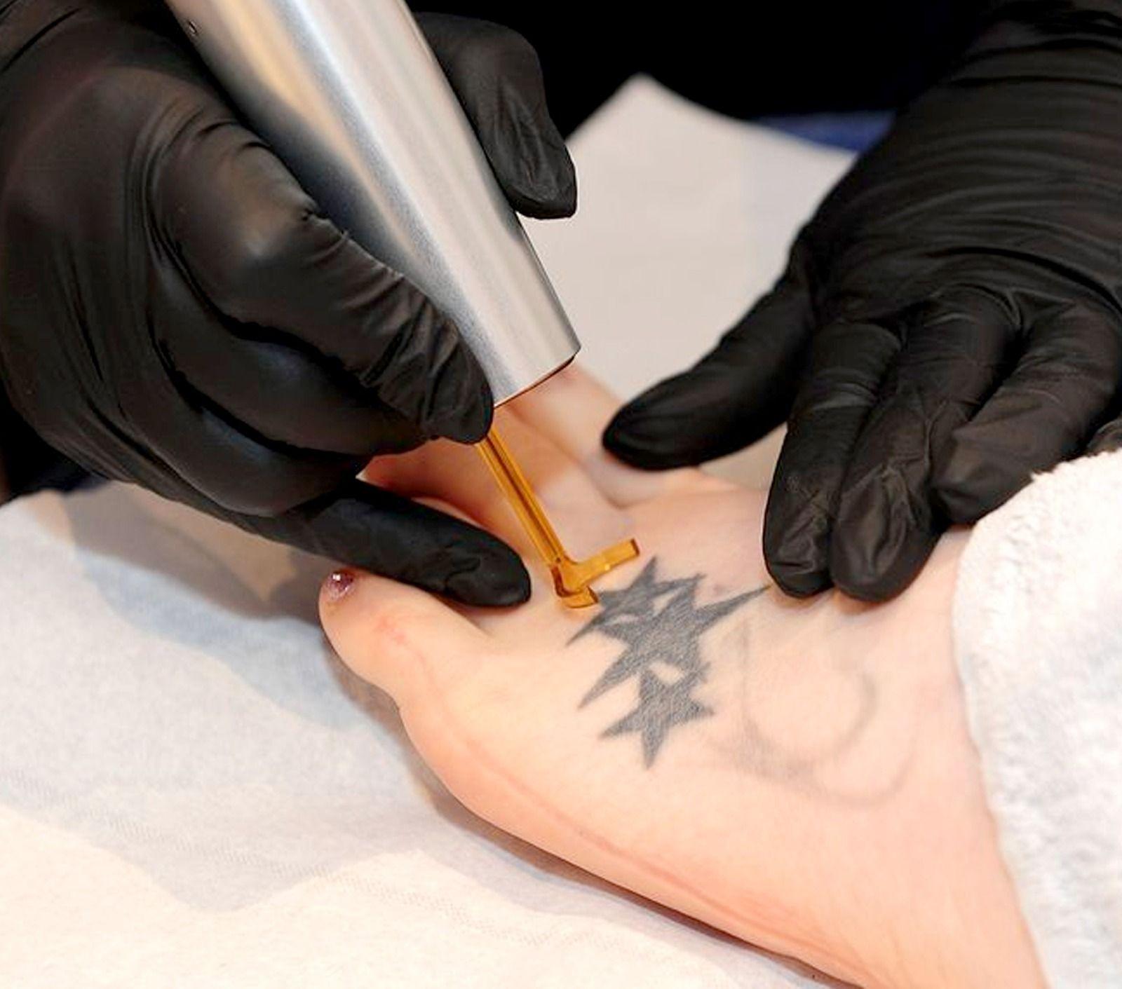 Tattoo Removal Treatment