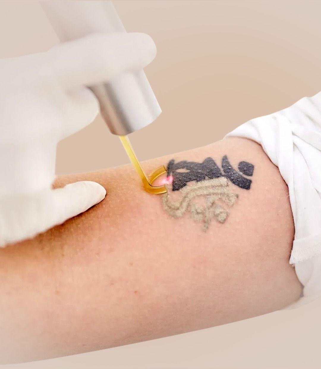 Tattoo Removal Treatment